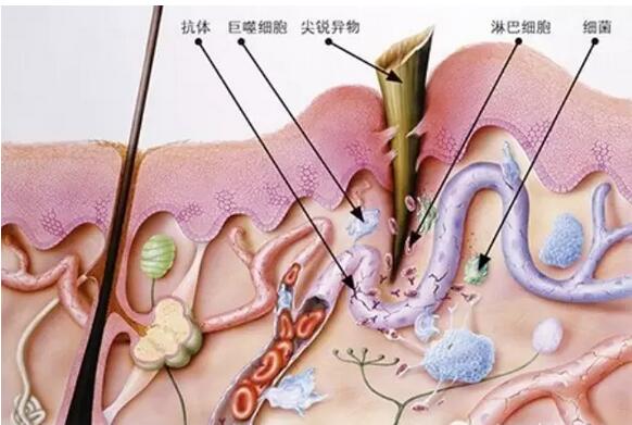 為什么傷口會(huì)發(fā)炎