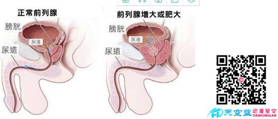 經(jīng)尿道前列腺等離子雙極電切術(shù)動(dòng)畫視頻d.jpg