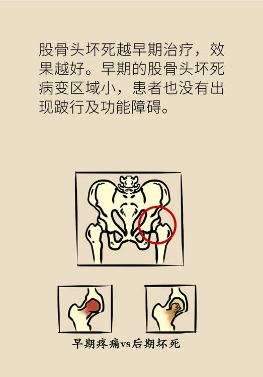 激素會帶來股骨頭壞死的后遺癥嗎？