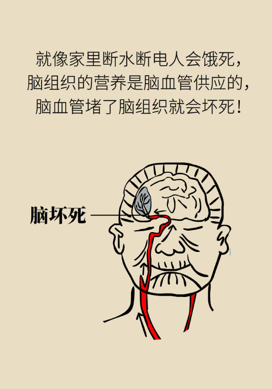 腔隙性腦梗死一定是腦血管堵了嗎？