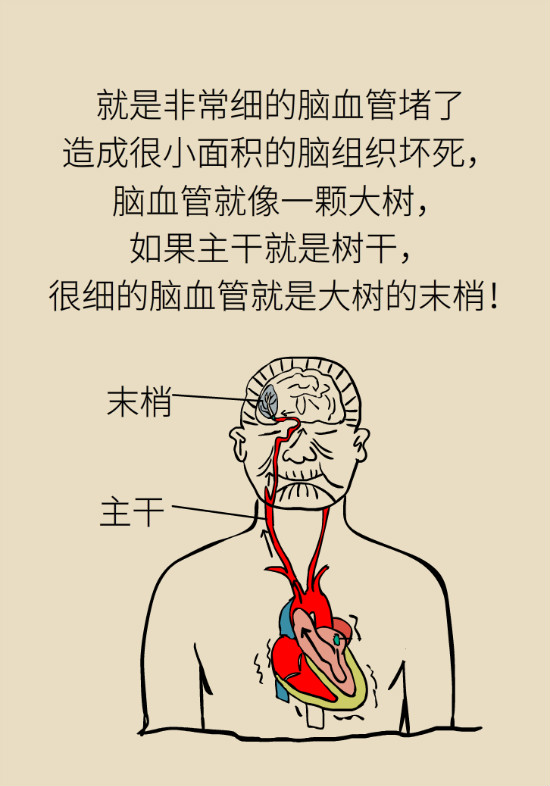 腔隙性腦梗死一定是腦血管堵了嗎？