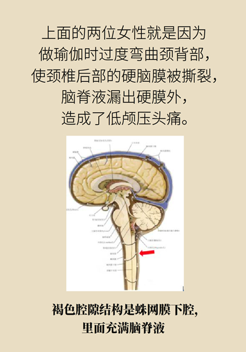 練瑜伽把腦脊液拉漏了！常見的“瑜伽病”你知道多少