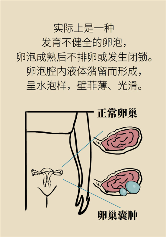 卵巢囊腫科普動漫：卵巢囊腫是腫瘤嗎？要學(xué)會這樣區(qū)分