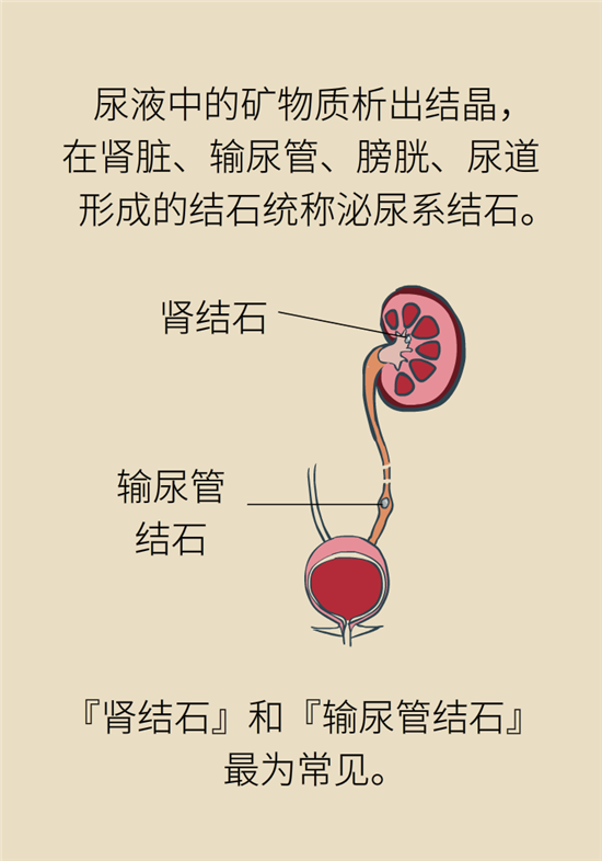 結(jié)石科普：身體里多了各種結(jié)石，應(yīng)該怎么辦？