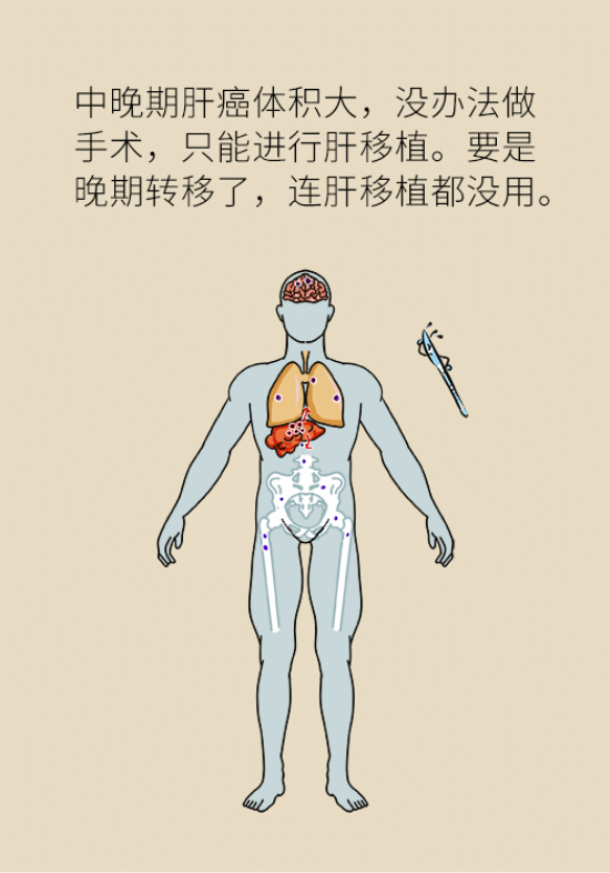 論發(fā)現(xiàn)早期肝癌的本事，cfDNA比AFP更精準，比影像學更早一步