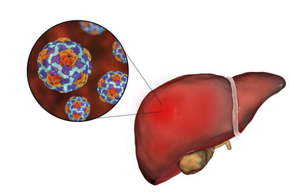 世界肝炎日：得了肝炎一定會得肝癌嗎？