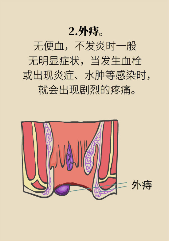 長(zhǎng)“痔”如何久安？專家的建議來(lái)了