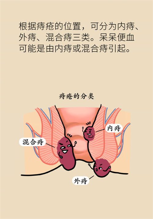 肛門腫脹還有血？小心痔瘡找上門