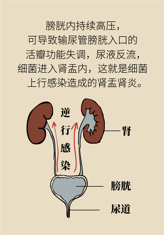 經(jīng)常憋尿會(huì)得急性腎炎？