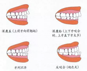 兒童換牙常見3大問題，保護(hù)牙齒需要做好這5點(diǎn)