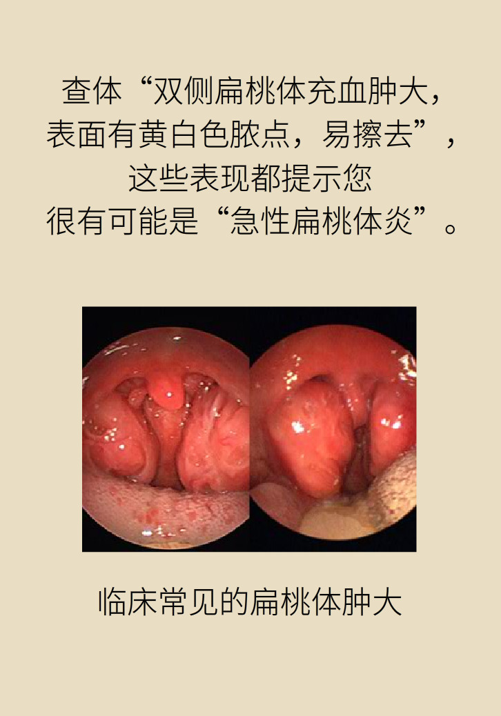 單側扁桃體腫大更兇險！謹防惡性腫瘤