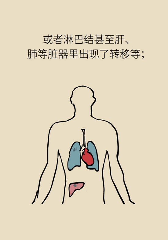 乳腺癌復(fù)發(fā)、轉(zhuǎn)移了怎么辦？