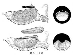 經(jīng)尿道前列腺切除術(shù)